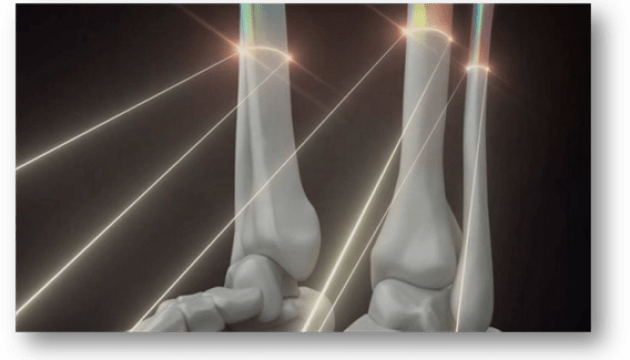 Україна виготовлятиме 3D імпланти кісток для допомоги постраждалим у війні - МОЗ