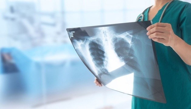 Штучний інтелект навчили передбачати ризик серцевого нападу й інсульту за рентгеном