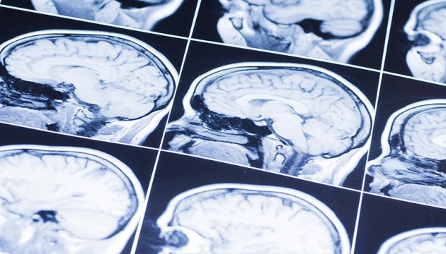 Гострий мозковий інсульт: що входить до безоплатного лікування